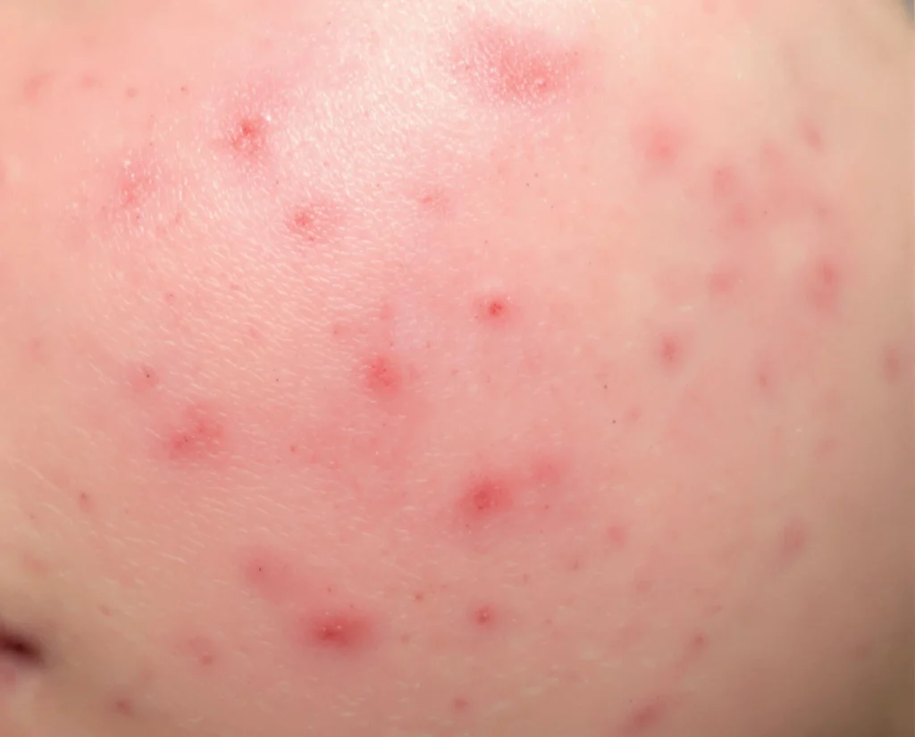 Acne Close Up