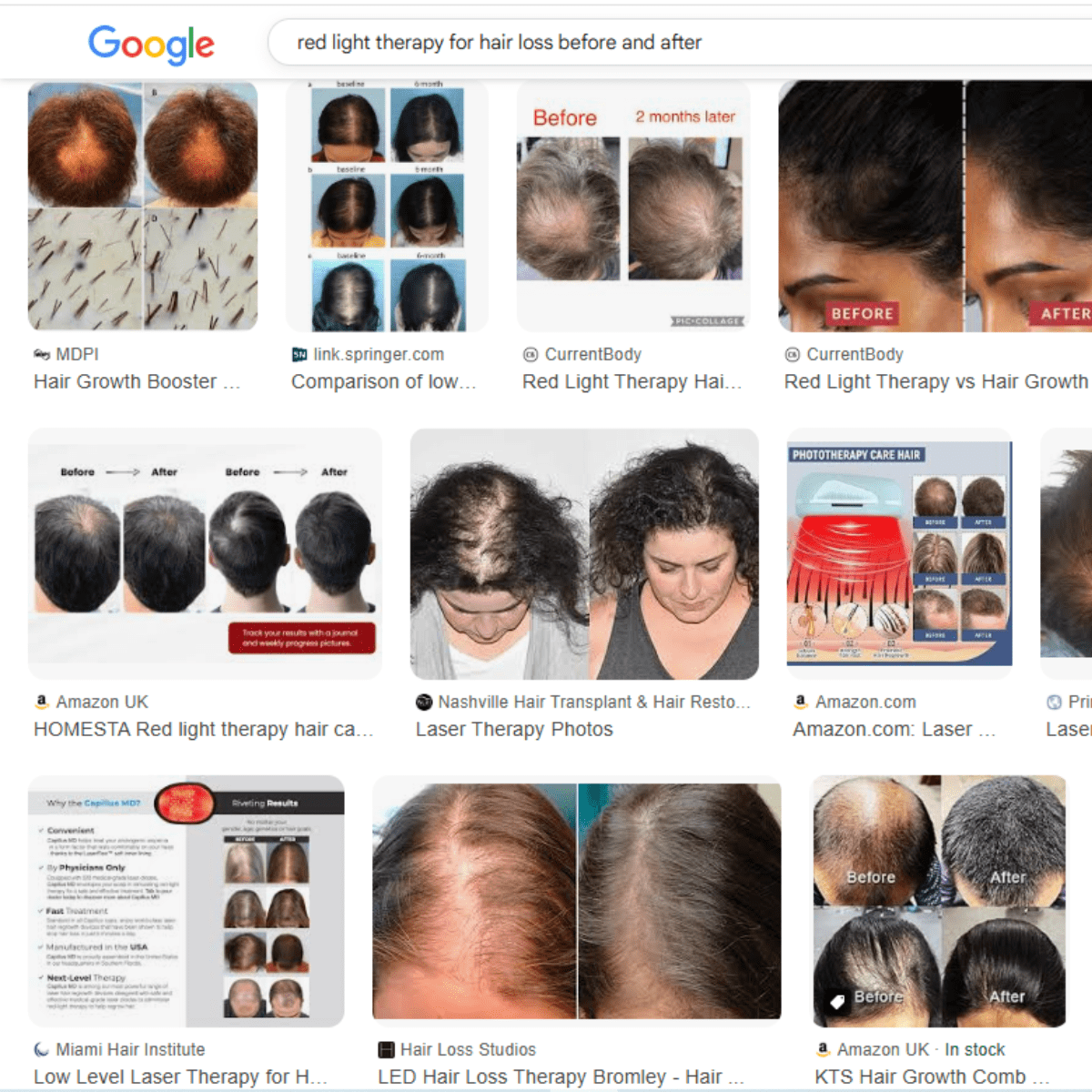 Before After Hair Growth Red Light Therapy