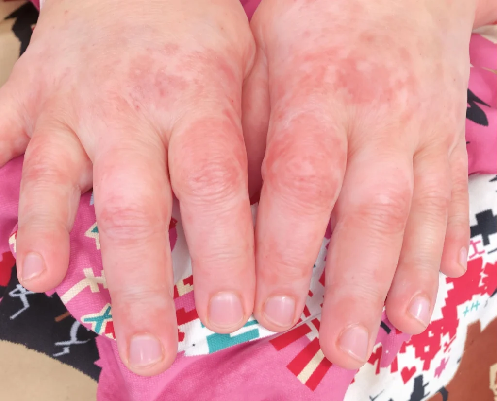 Close-up of a child's hands with visible eczema, showing red, irritated skin and inflammation on the fingers and knuckles